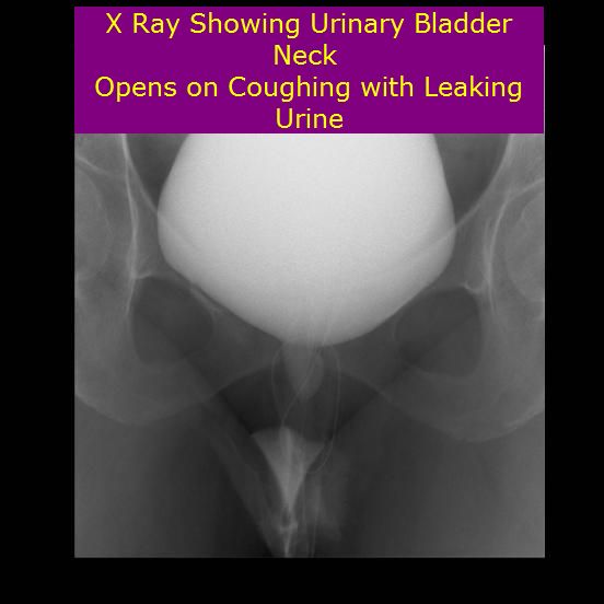Bladder neck and Urethra opens on coughing SeragYoussif; Bladder neck and Urethra opens on coughing SeragYoussif;